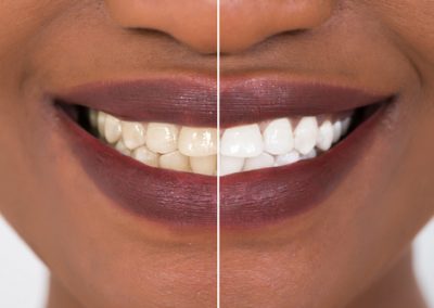 Teeth Whitening